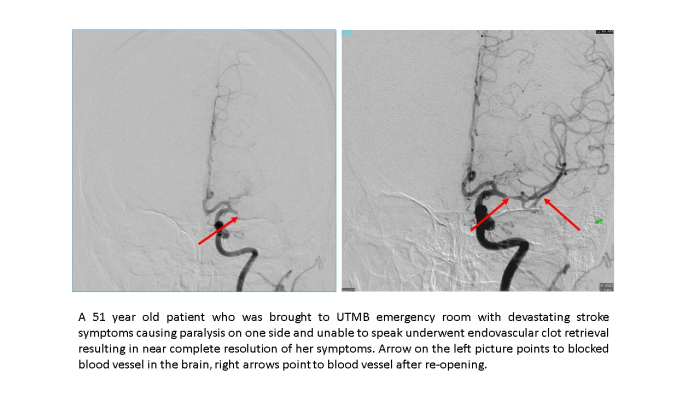 UTMB offers latest treatment for stroke victims
