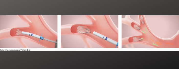 UTMB uses newly approved valve to help patients breathe easier